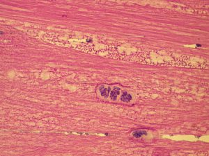 Tracheobronchialsekret Muzin und Neutr. Granulozyten